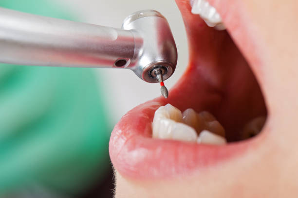 Best Emergency Root Canal Treatment in Maple Grove, MN